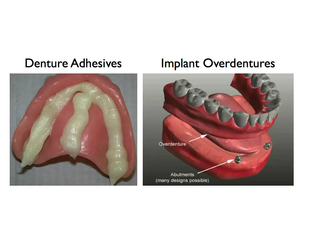 How To Glue In Dentures