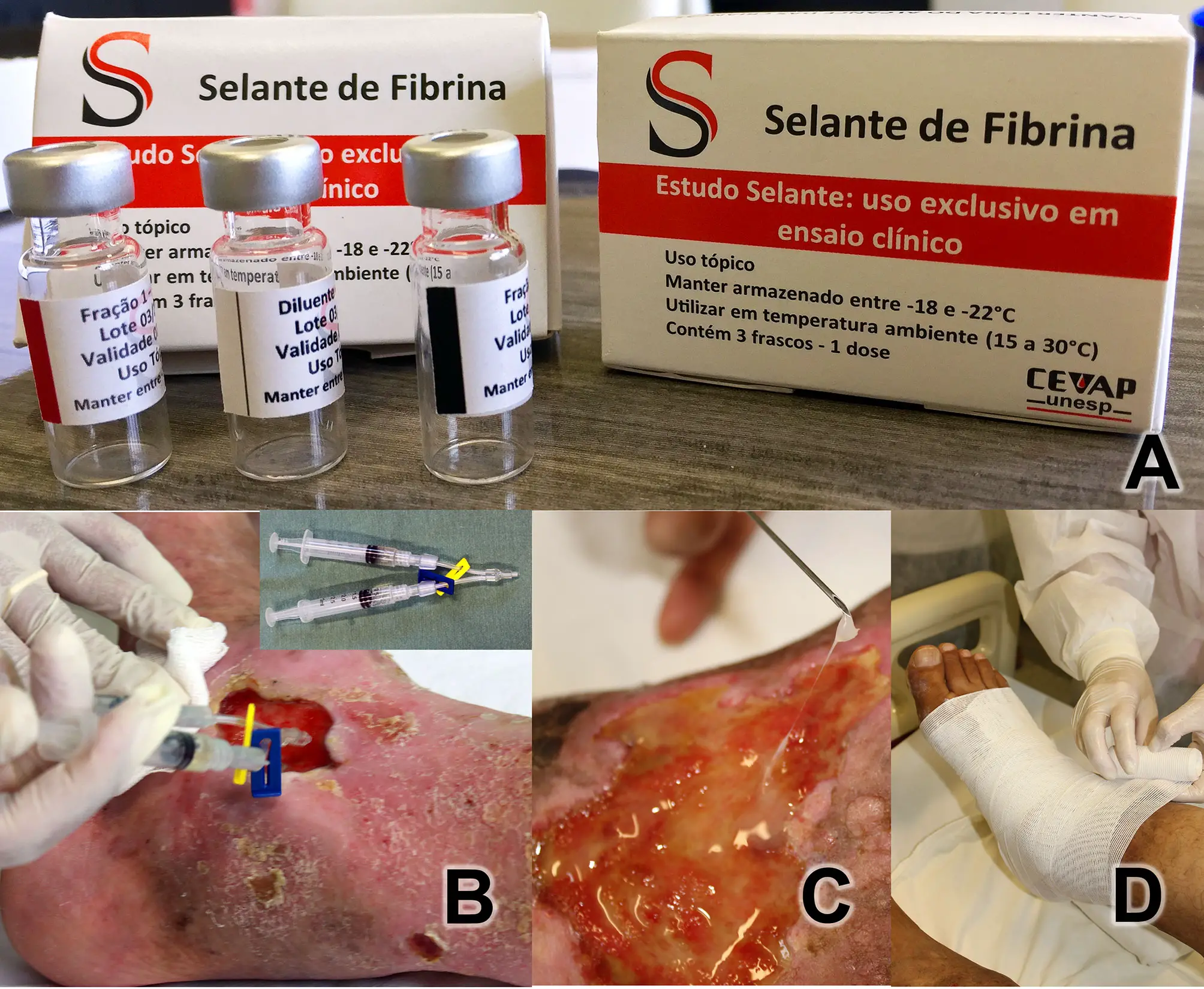 How To Use Fibrin Glue