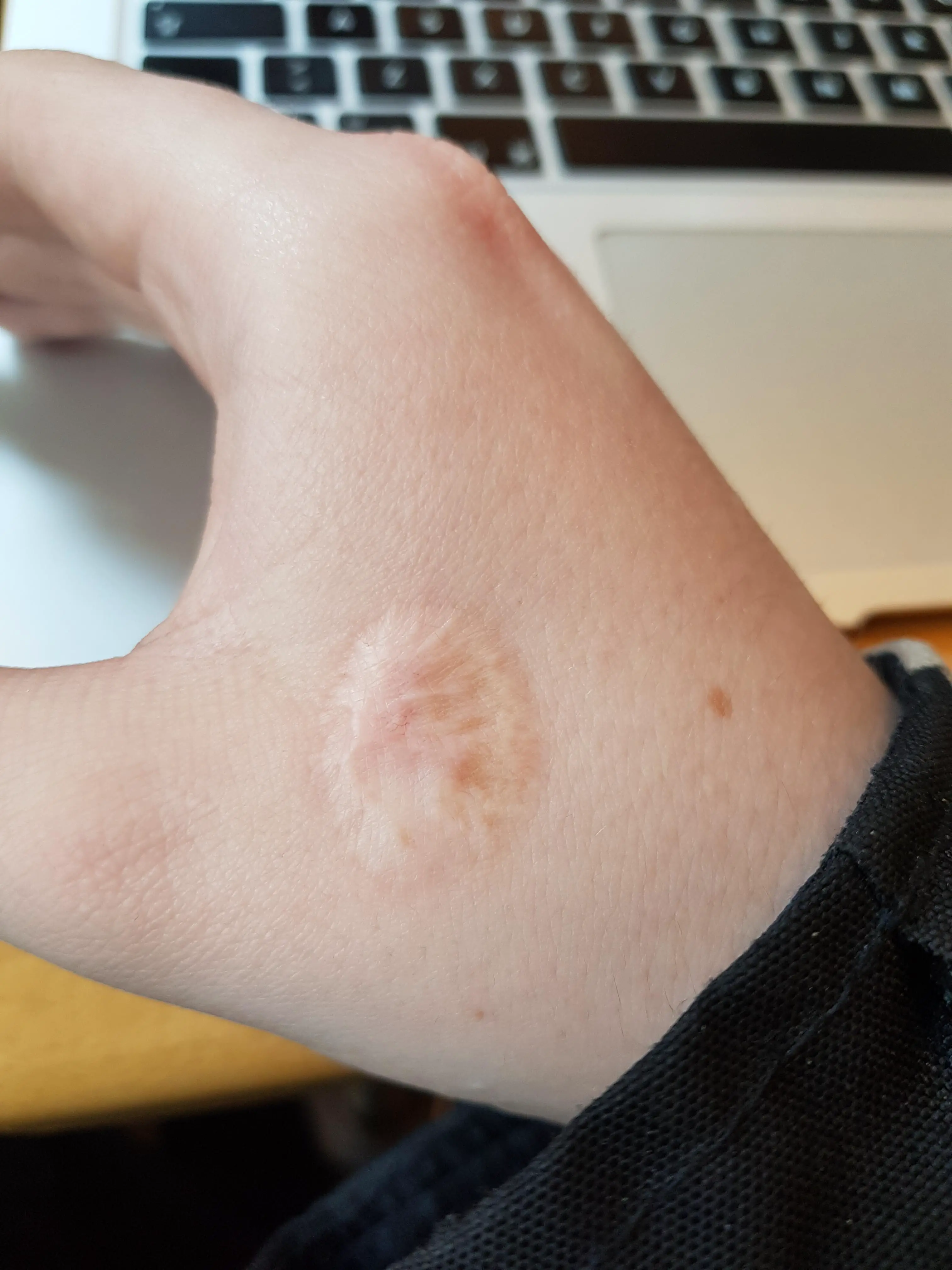 What Happens If You Get Hot Glue On Your Skin